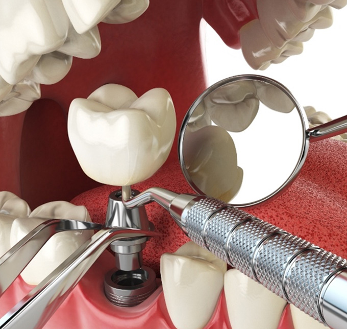 Digital image of a dental implant placement procedure in Albuquerque