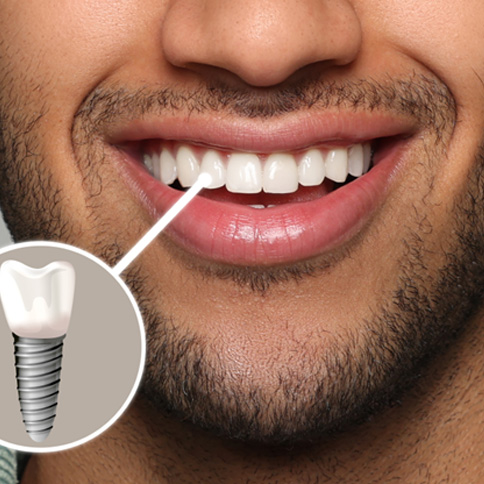 Digital image of a dental implant and its placement in a person’s mouth