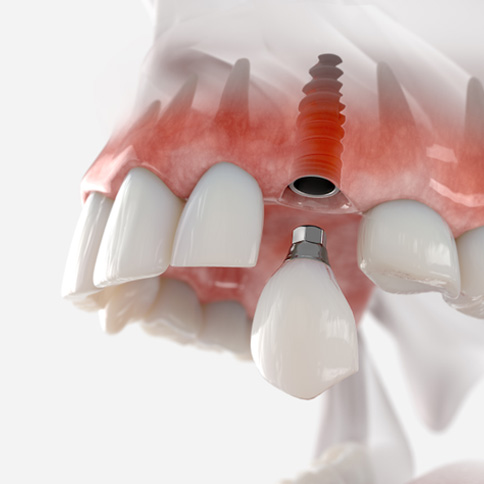 Digital image of the custom restoration fitting on top of the implant post