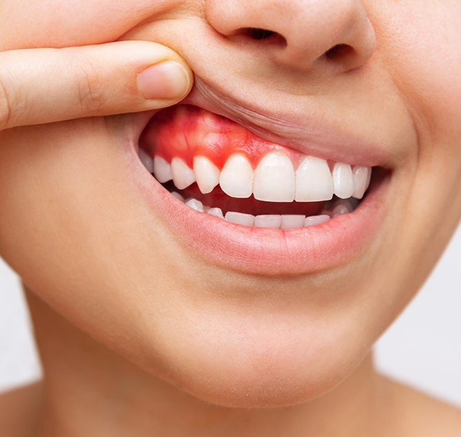 Woman with red and swollen gums