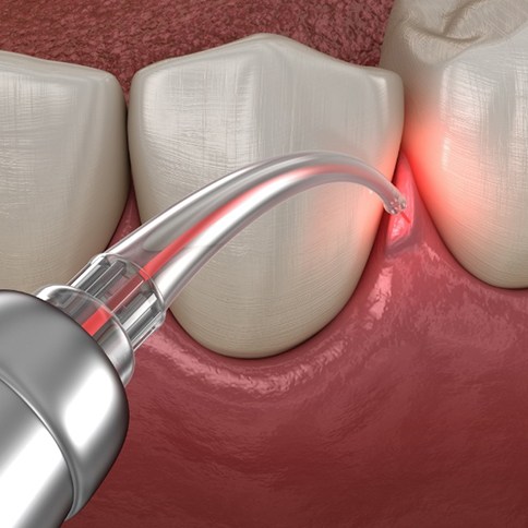 Digital image of laser periodontal treatment