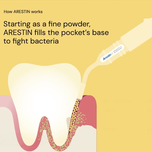 Tooth and how Arestin works