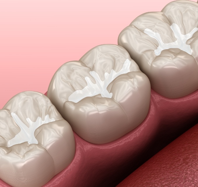 Illustration of teeth with tooth colored fillings