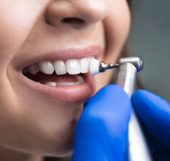 Close up of teeth during a dental cleaning