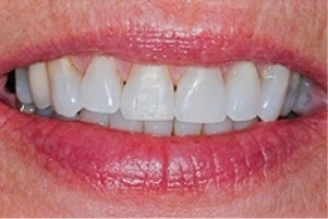 Teeth after treatment