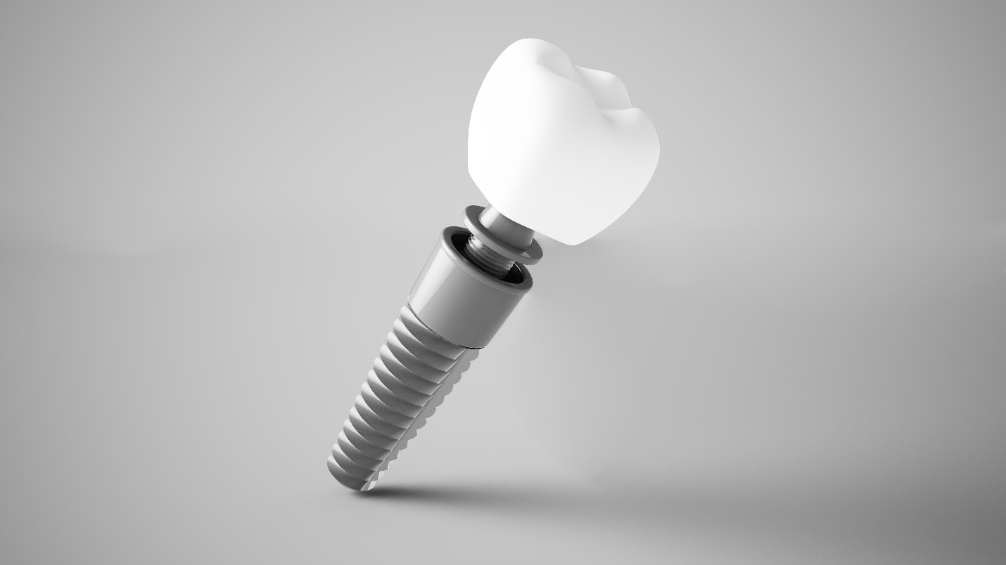 Can I Get MetalFree Dental Implants in Albuquerque?