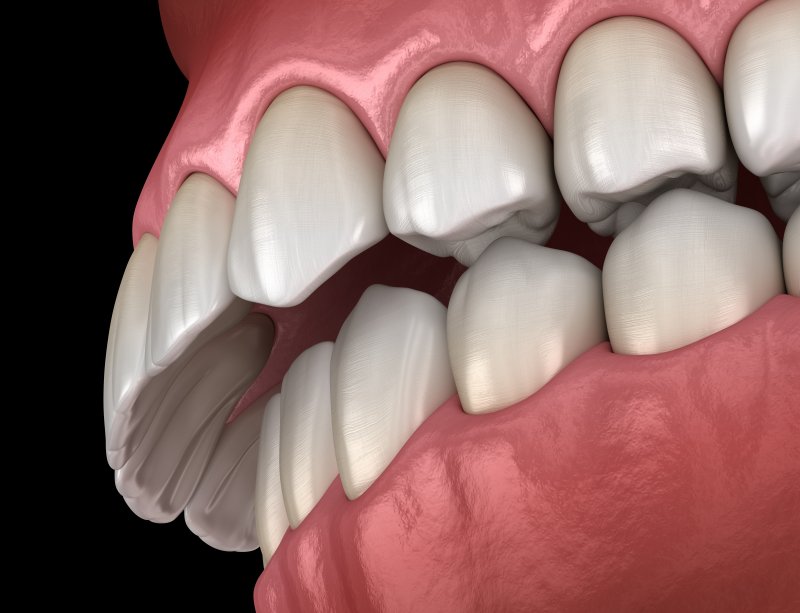 digital image of an overbite